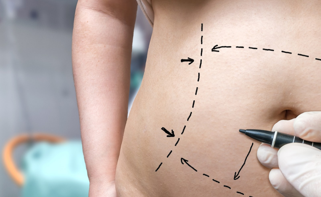 Maximizing Your Tummy Tuck: Proven Strategies for Long-Lasting Results